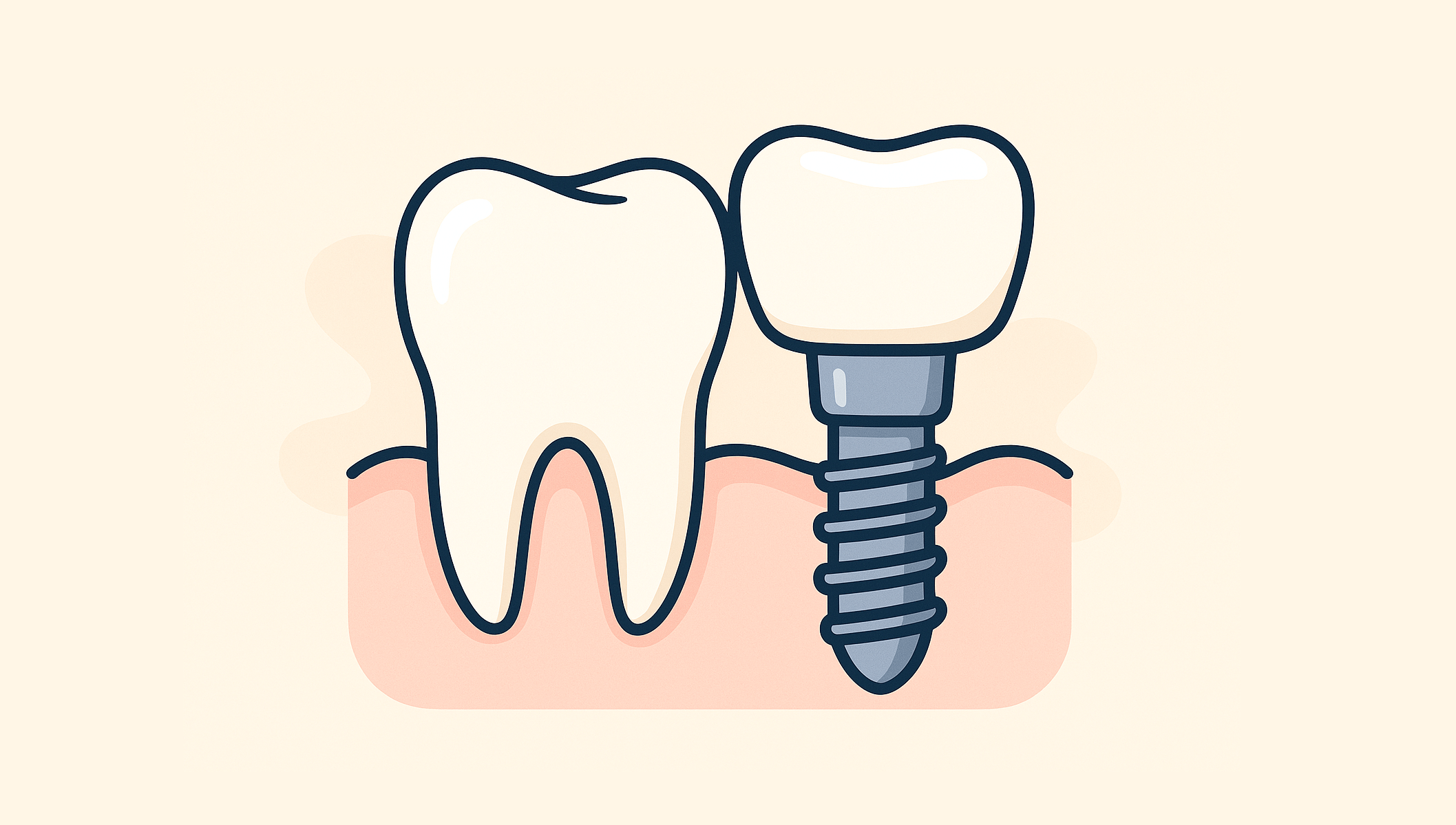 Имплантация